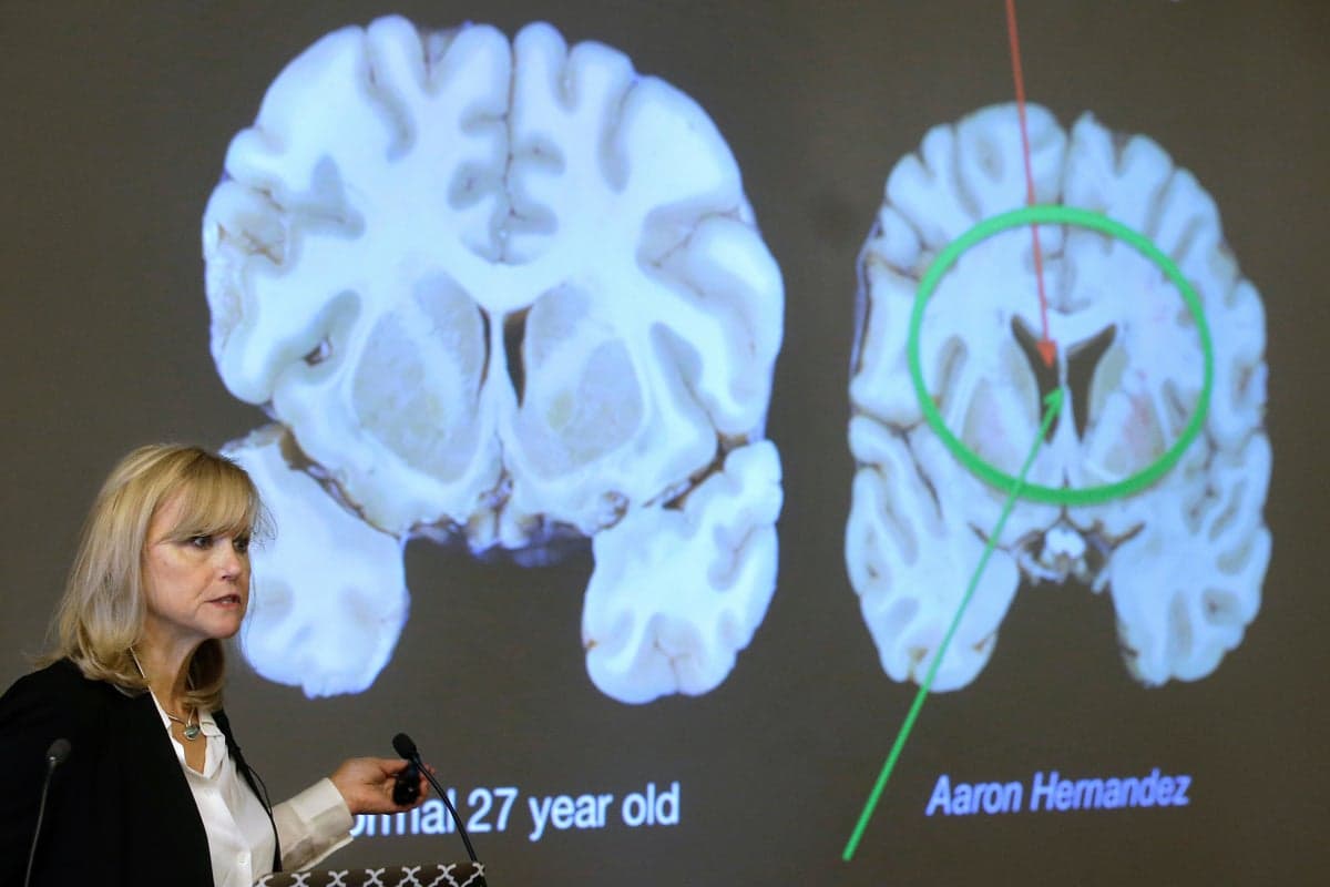 One in four NFL players could get CTE, alarming new study finds